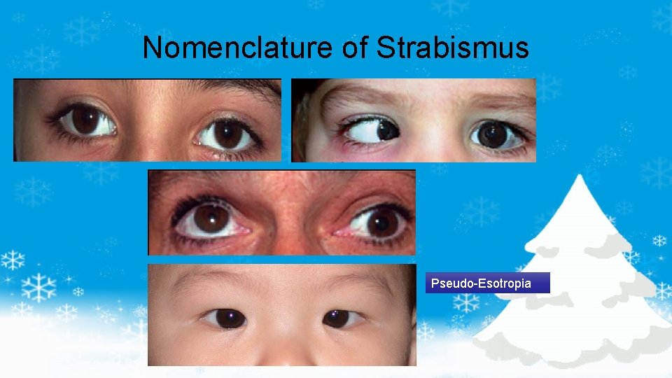 Nomenclature of Strabismus Pseudo-Esotropia 
