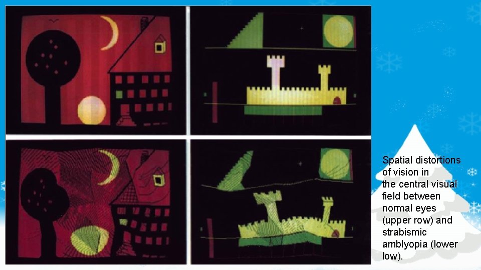 Spatial distortions of vision in the central visual field between normal eyes (upper row)