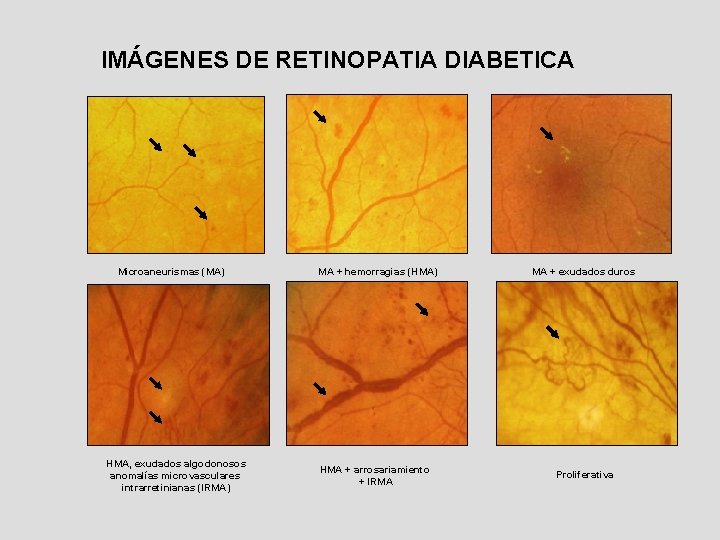 IMÁGENES DE RETINOPATIA DIABETICA Microaneurismas (MA) HMA, exudados algodonosos anomalías microvasculares intrarretinianas (IRMA) MA