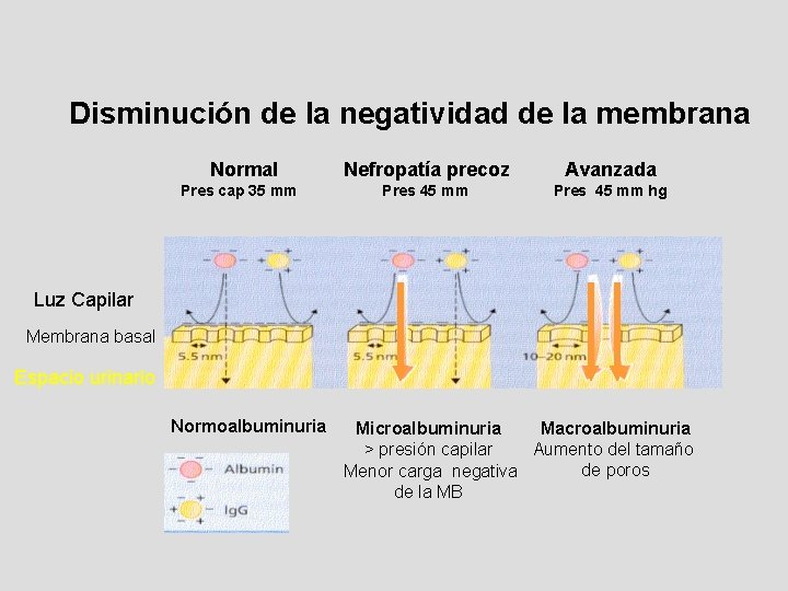 Disminución de la negatividad de la membrana Normal Pres cap 35 mm Nefropatía precoz Disminución de la negatividad de la membrana Normal Pres cap 35 mm Nefropatía precoz