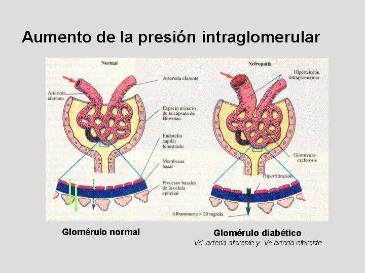 Aumento de la presión intraglomerular Glomérulo normal Glomérulo diabético Vd arteria aferente y Vc Aumento de la presión intraglomerular Glomérulo normal Glomérulo diabético Vd arteria aferente y Vc