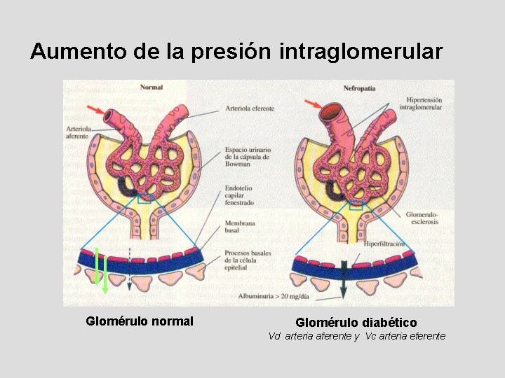 Aumento de la presión intraglomerular Glomérulo normal Glomérulo diabético Vd arteria aferente y Vc