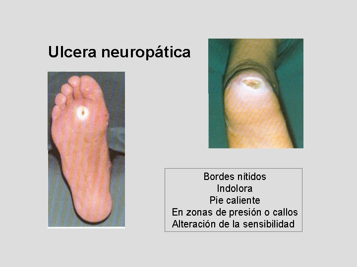 Ulcera neuropática Bordes nítidos Indolora Pie caliente En zonas de presión o callos Alteración Ulcera neuropática Bordes nítidos Indolora Pie caliente En zonas de presión o callos Alteración