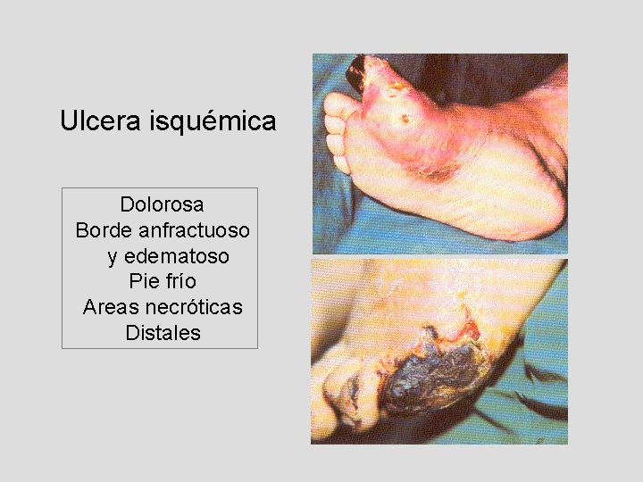 Ulcera isquémica Dolorosa Borde anfractuoso y edematoso Pie frío Areas necróticas Distales 