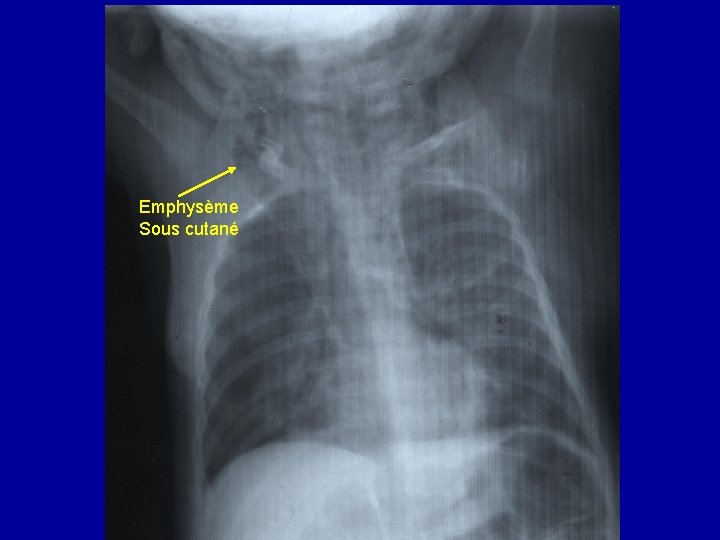 Emphysème Sous cutané 