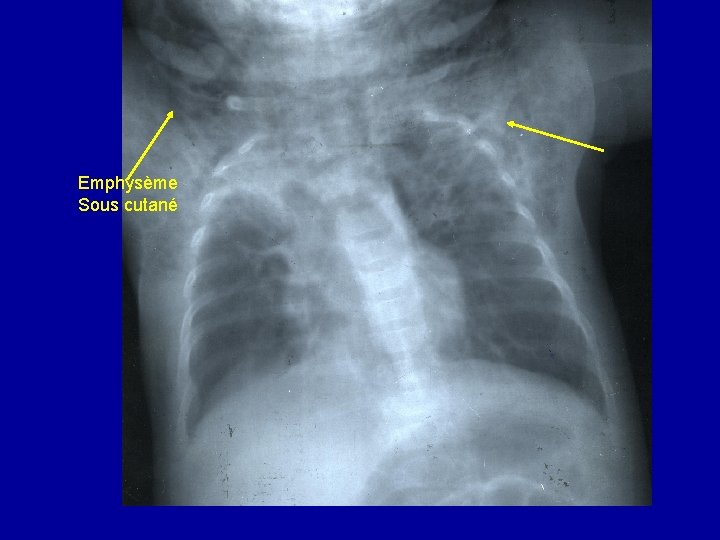 Emphysème Sous cutané 