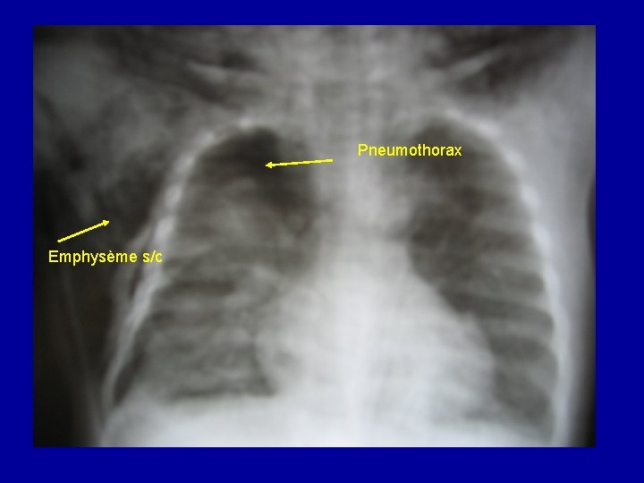 Pneumothorax Emphysème s/c 