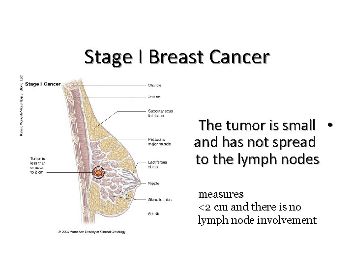 Stage I Breast Cancer The tumor is small • and has not spread to