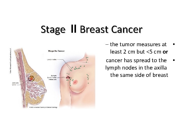 Stage II Breast Cancer – the tumor measures at • least 2 cm but