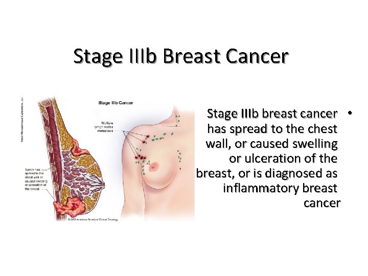 Stage IIIb Breast Cancer Stage IIIb breast cancer • has spread to the chest