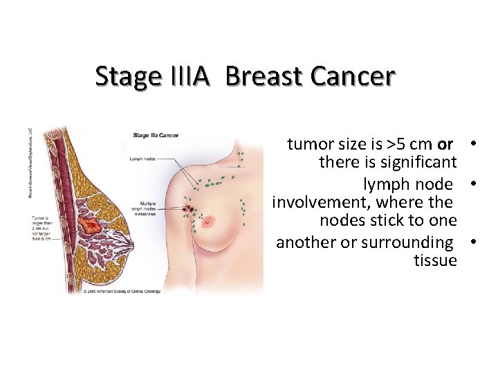 Stage IIIA Breast Cancer tumor size is >5 cm or • there is significant