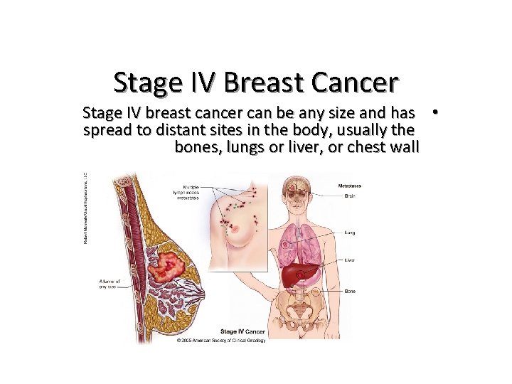 Stage IV Breast Cancer Stage IV breast cancer can be any size and has