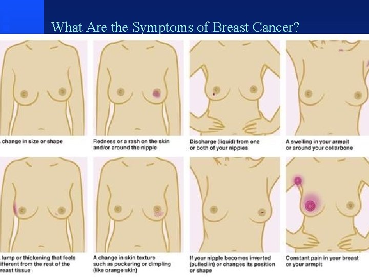 What Are the Symptoms of Breast Cancer? 