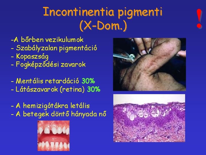 Incontinentia pigmenti (X-Dom. ) -A bőrben vezikulumok - Szabályzalan pigmentáció - Kopaszság - Fogképződési