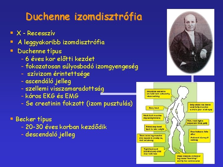 Duchenne izomdisztrófia § § § X - Recesszív A leggyakoribb izomdisztrófia Duchenne típus -