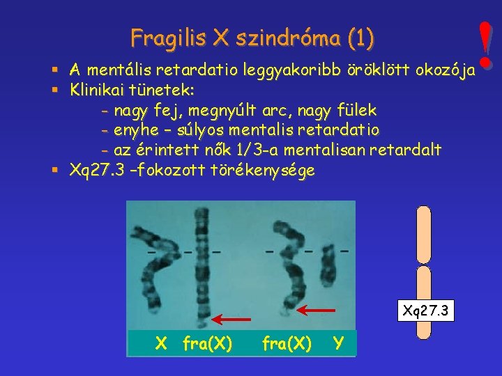 ! Fragilis X szindróma (1) § A mentális retardatio leggyakoribb öröklött okozója § Klinikai