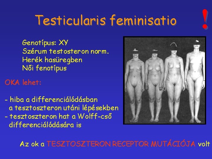 Testicularis feminisatio ! Genotípus: XY Szérum testosteron norm. Herék hasüregben Női fenotípus OKA lehet: