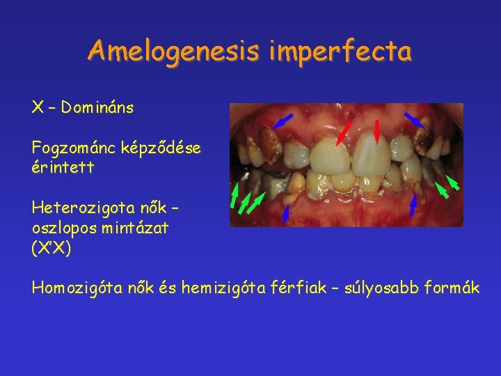 Amelogenesis imperfecta X – Domináns Fogzománc képződése érintett Heterozigota nők – oszlopos mintázat (X’X)