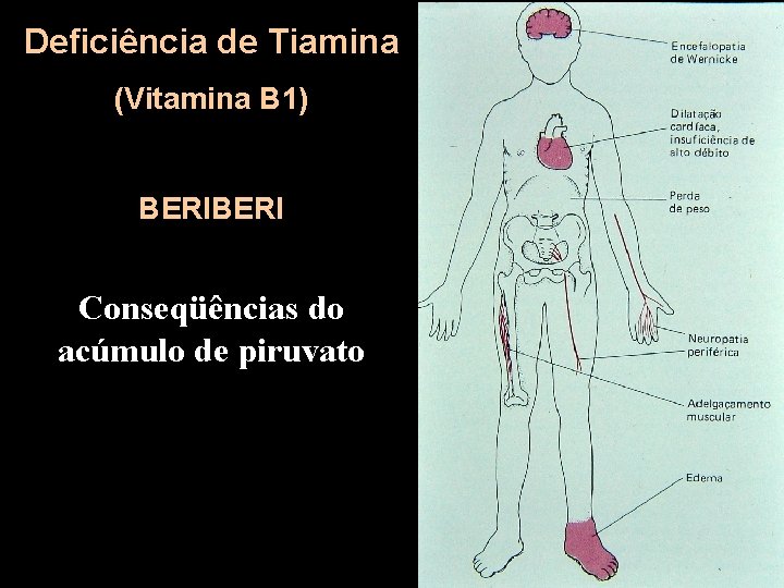 Deficiência de Tiamina (Vitamina B 1) BERI Conseqüências do acúmulo de piruvato 