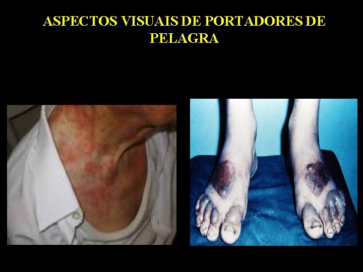 ASPECTOS VISUAIS DE PORTADORES DE PELAGRA 
