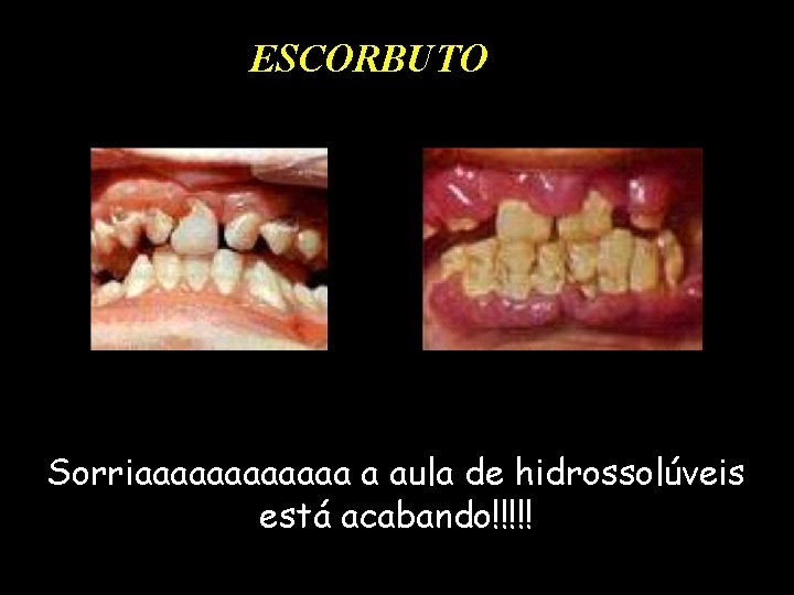 ESCORBUTO Sorriaaaaaa a aula de hidrossolúveis está acabando!!!!! 