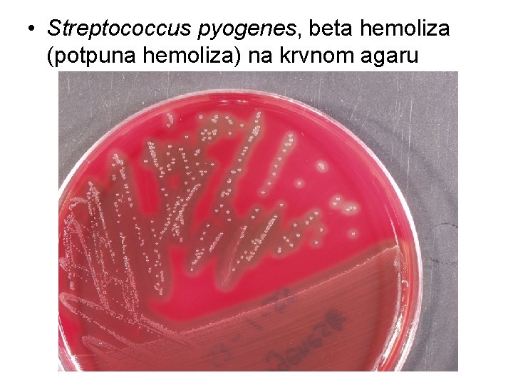 • Streptococcus pyogenes, beta hemoliza (potpuna hemoliza) na krvnom agaru • Streptococcus pyogenes, beta hemoliza (potpuna hemoliza) na krvnom agaru