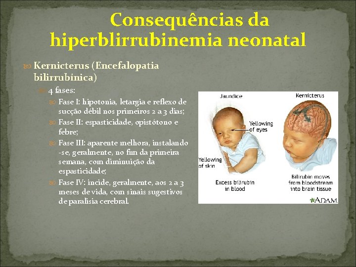  Consequências da hiperblirrubinemia neonatal Kernicterus (Encefalopatia bilirrubínica) 4 fases: Fase I: hipotonia, letargia