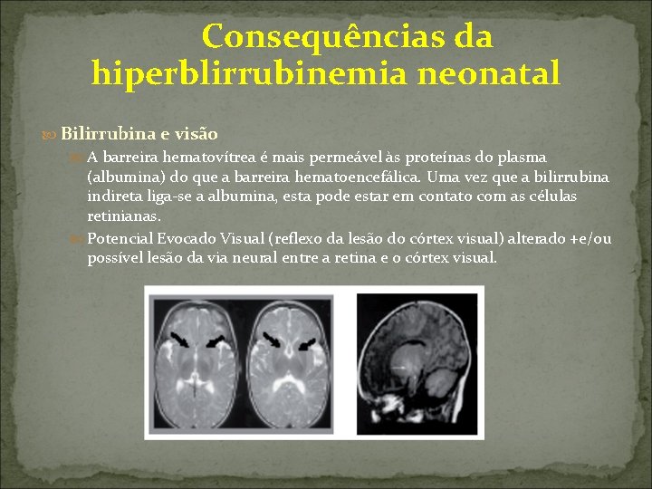  Consequências da hiperblirrubinemia neonatal Bilirrubina e visão A barreira hematovítrea é mais permeável