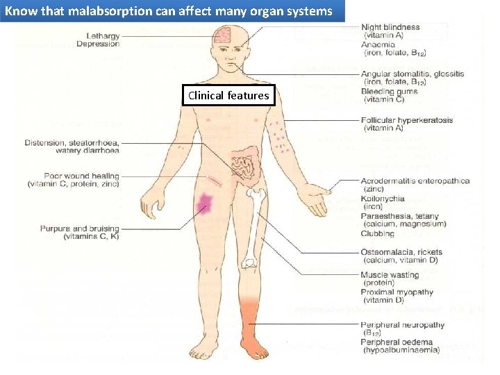 Know that malabsorption can affect many organ systems Clinical features 