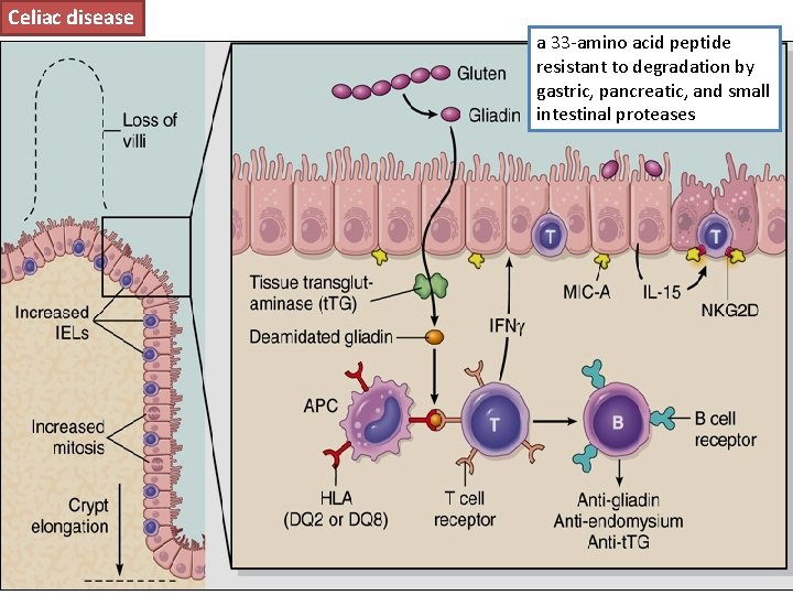 Celiac disease a 33 -amino acid peptide resistant to degradation by gastric, pancreatic, and
