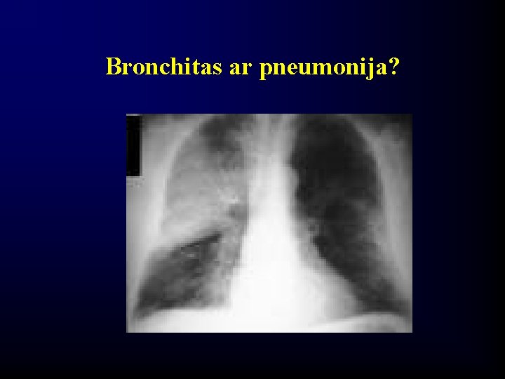 Bronchitas ar pneumonija? 