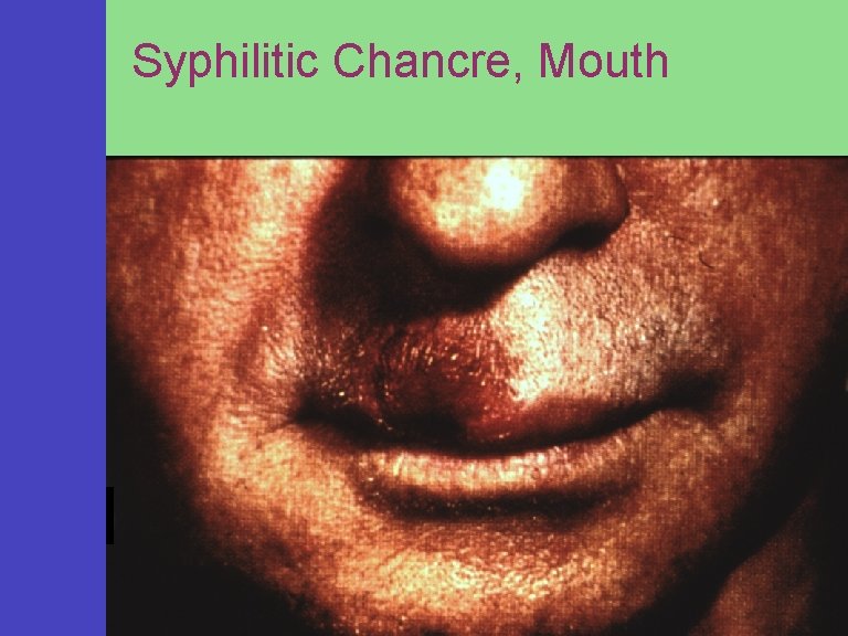 Syphilitic Chancre, Mouth 