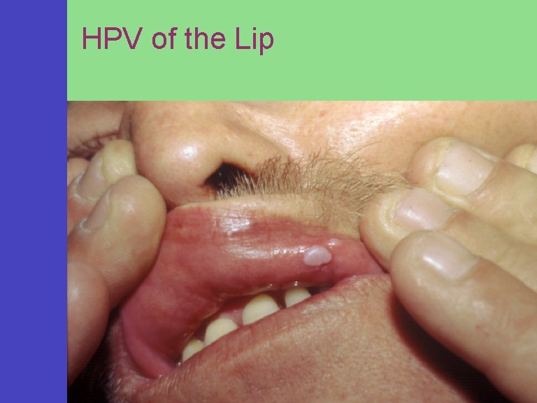 HPV of the Lip 
