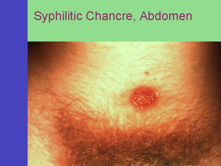 Syphilitic Chancre, Abdomen 