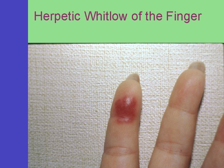 Herpetic Whitlow of the Finger 