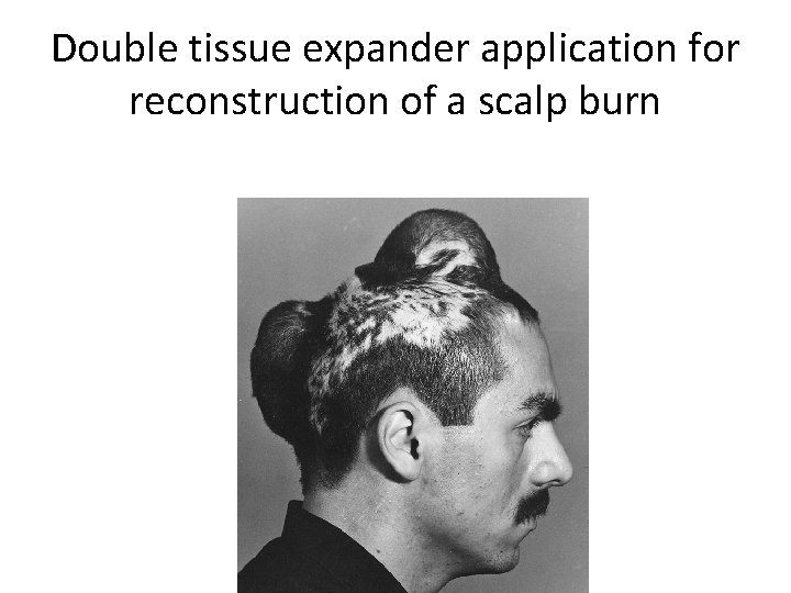 Double tissue expander application for reconstruction of a scalp burn 