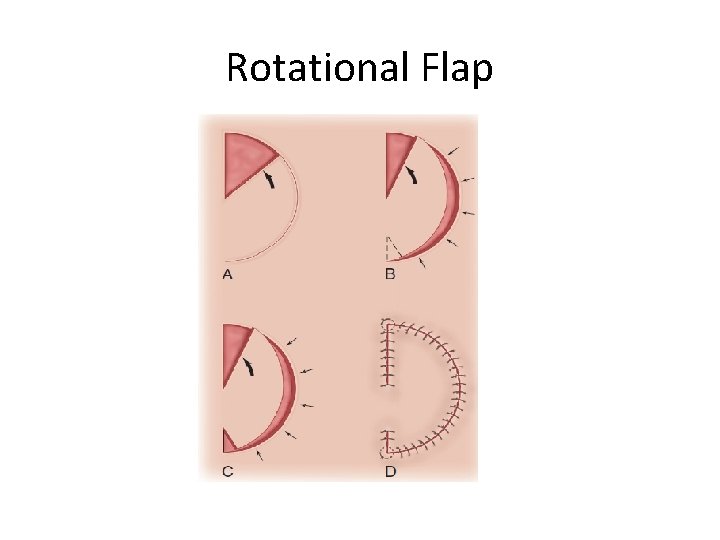 Rotational Flap 