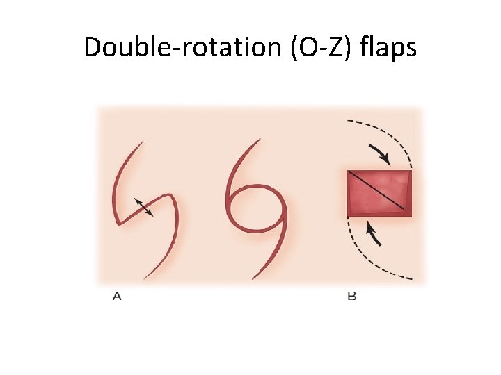 Double-rotation (O-Z) flaps 
