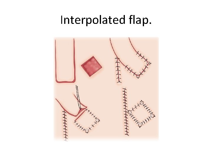 Interpolated flap. 