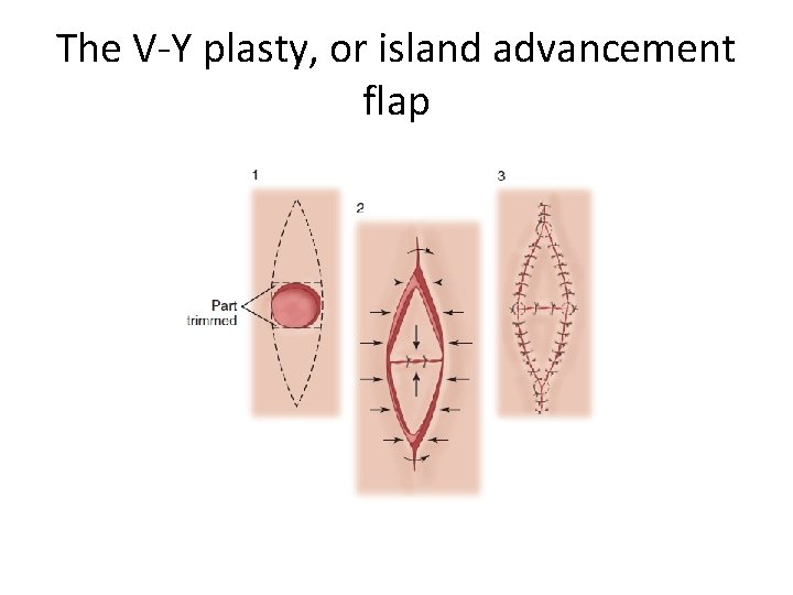 The V-Y plasty, or island advancement flap 