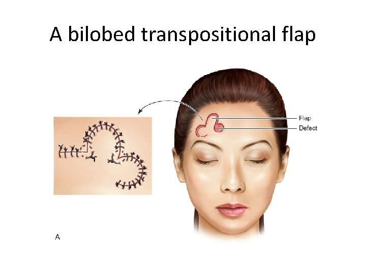 A bilobed transpositional flap 