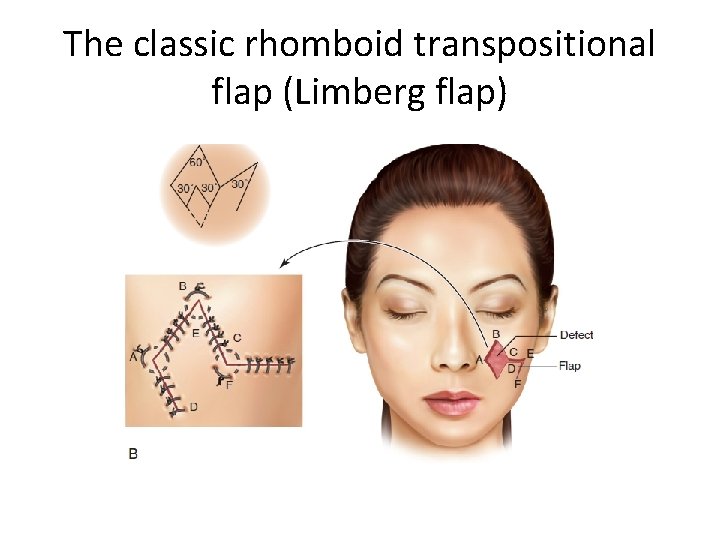 The classic rhomboid transpositional flap (Limberg flap) 