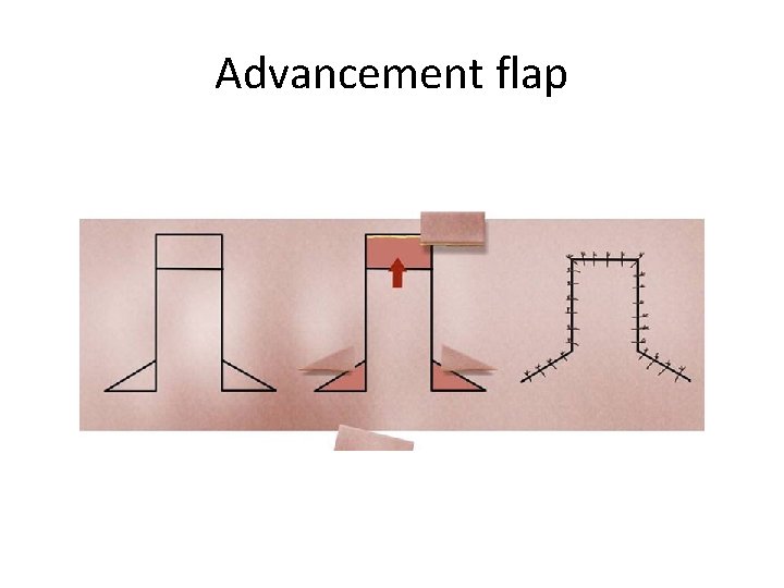Advancement flap 