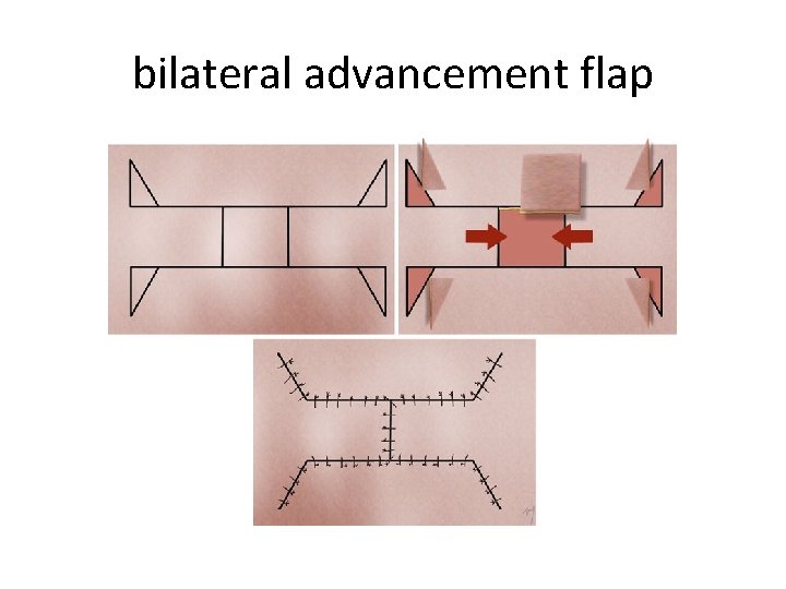 bilateral advancement flap 