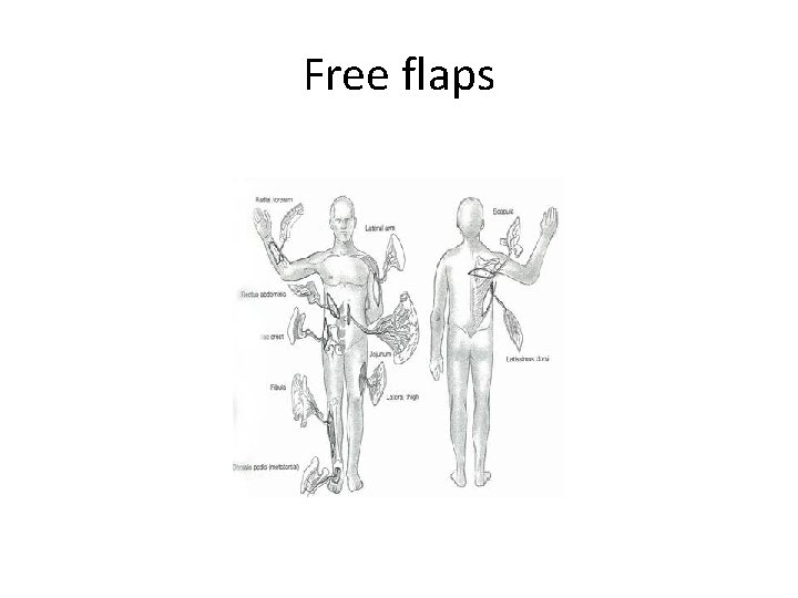 Free flaps 