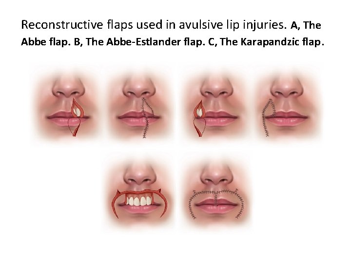 Reconstructive flaps used in avulsive lip injuries. A, The Abbe flap. B, The Abbe-Estlander