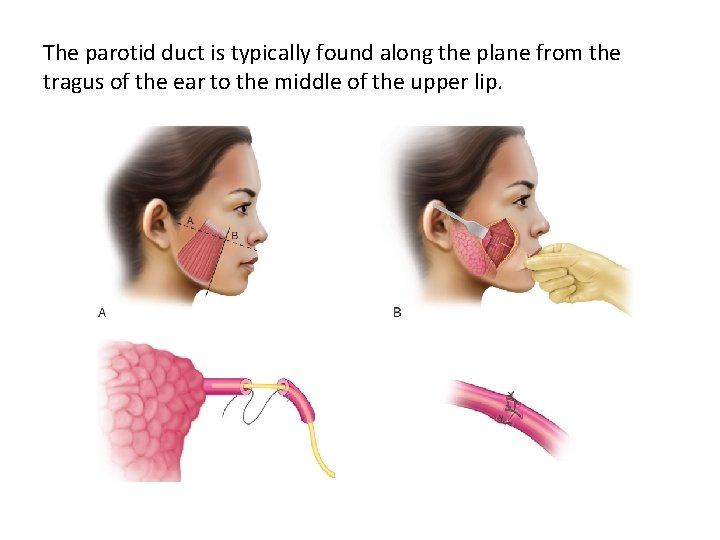 The parotid duct is typically found along the plane from the tragus of the