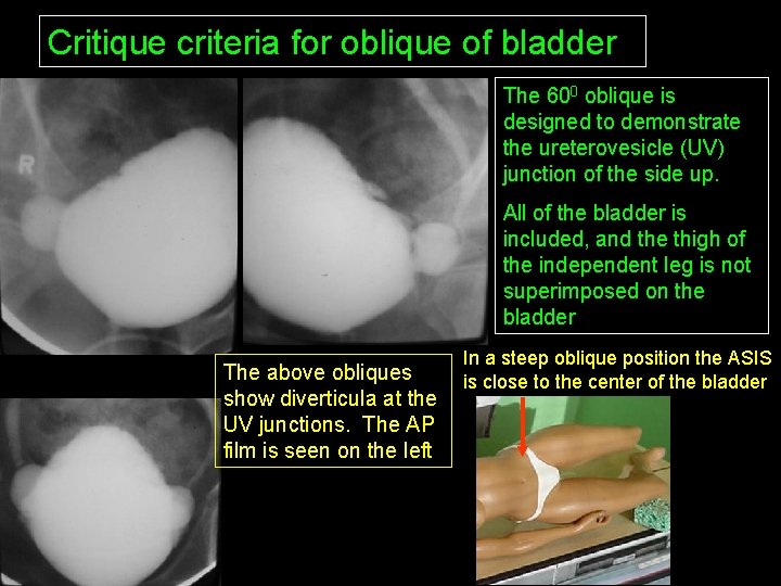 Critique criteria for oblique of bladder The 600 oblique is designed to demonstrate the