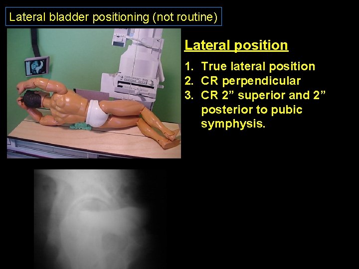 Lateral bladder positioning (not routine) Lateral position 1. True lateral position 2. CR perpendicular