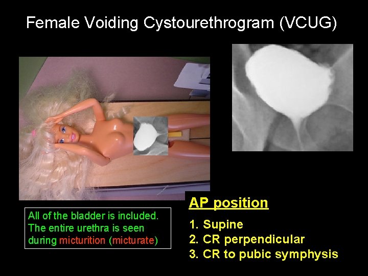 Female Voiding Cystourethrogram (VCUG) All of the bladder is included. The entire urethra is